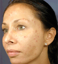 Chemical Peel, Vi peel, Acne Treatment New York City Manhattan